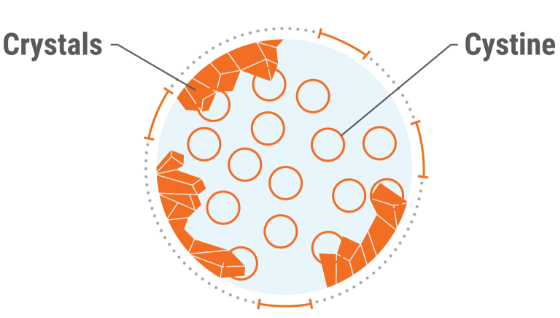 Targeting cystinosis treatment goals