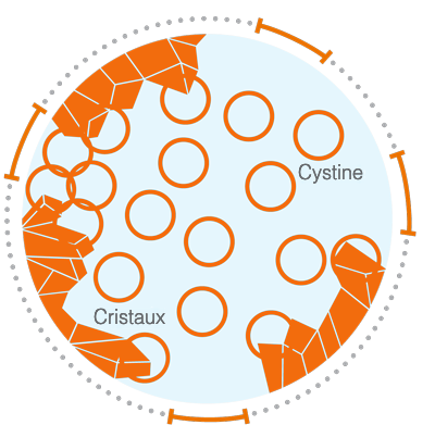 Lysosome chez une personne atteinte de cystinose